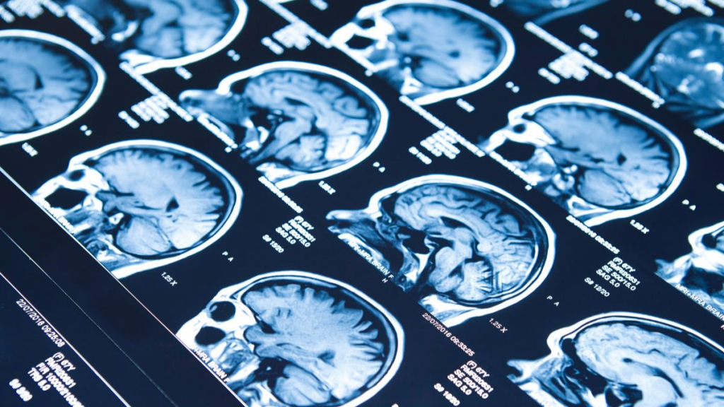 Desarrollan el primer fármaco que permite recuperación total tras un derrame cerebral