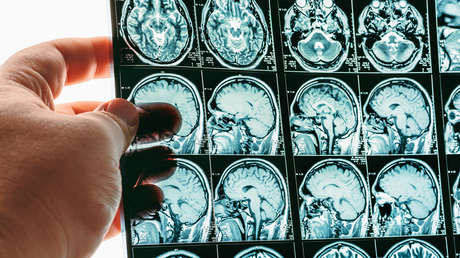 Descartan existencia de misterioso trastorno cerebral en Canadá