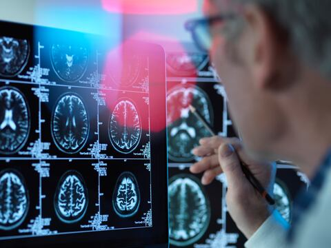 Mayo Clinic desarrolla herramienta de IA que detecta 9 tipos de demencia con una sola imagen cerebral