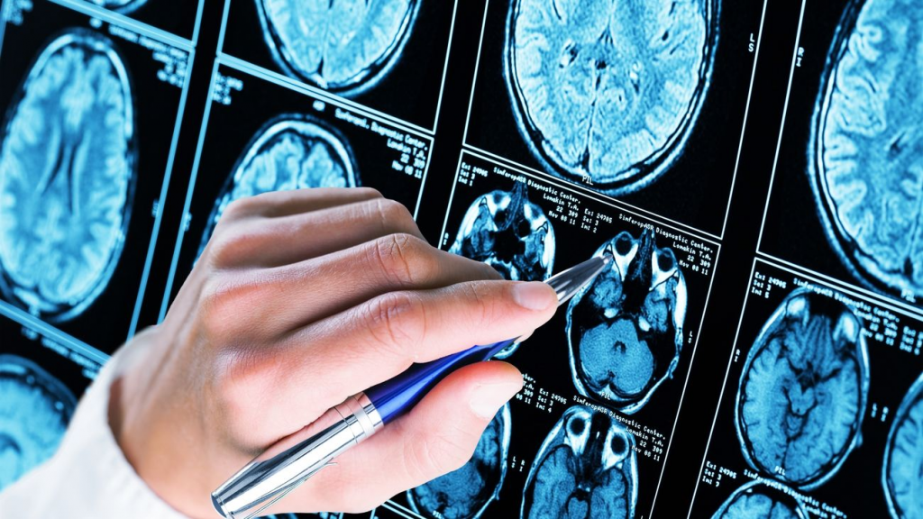 Nuevo tratamiento promete restaurar actividad cerebral en casos tempranos de párkinson
